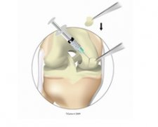 TiGenix ChondroCelect | Used in Articular cartilage repair  | Which Medical Device